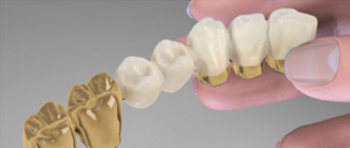 Crown-and Bridgework